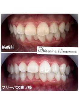 ホワイトニングサロン 京都烏丸店/ホワイトニング施術例