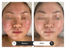 リジュ(Reje)/赤み&ニキビケア