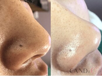 キャンディ 難波心斎橋店(CANDi)/ハイドラピーリング/黒ずみ毛穴