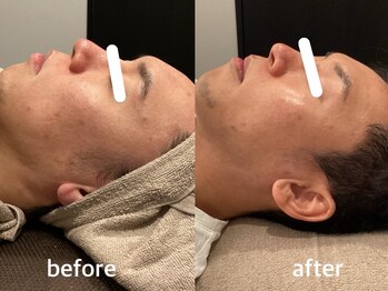 ヴィセラ(Vicella)/ニキビ肌のお悩みに!