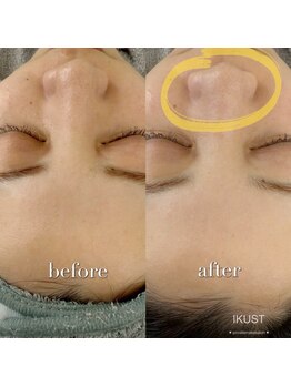 イクスト 吉祥寺(IKUST)/【フェイシャルワックス/脱毛】