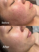 ワンネス(One’Ness)/ハーブピーリング