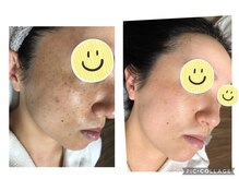 ウカ(uka)/シミケアのお客様♪