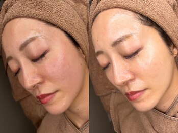 ラナン 恵比寿店(Ranun)/before/after ★ララピール