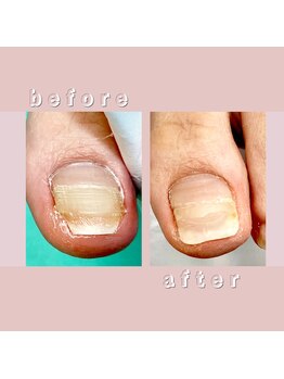 巻き爪補正店 大阪なんば店/再生補正