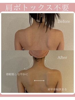 アティレ オオサカ(Attirer Osaka)/施術4回目/首肩周りの太さ解消