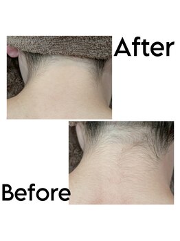 エミナル(EMINAL)/襟足脱毛で後ろ姿美人に! 脱毛