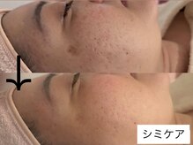 サロン ドロップ 上小田井(Salon drop)/「シミ改善」途中経過