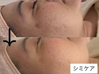 サロン ドロップ 上小田井(Salon drop)/「シミ改善」途中経過