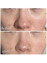 リコ(Relaxation Boutique LICO)/クマのお悩みにオーダーメイドF