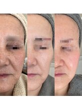 グレーシス(Graces)/Before/after【エイジング編】