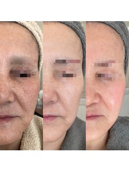 グレーシス(Graces)/Before/after【エイジング編】