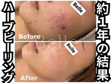 ベル 心斎橋店(Belle)/ハーブピーリング