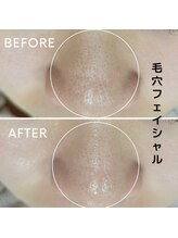 フェイエール鍼灸院 ラスィーヌ(fier鍼灸院 racine)/毛穴フェイシャル
