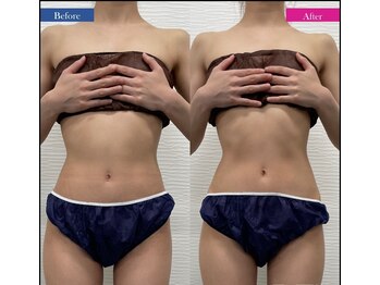 コリオ(KoRiO)/痩身1回目のお客様［狭山ヶ丘］