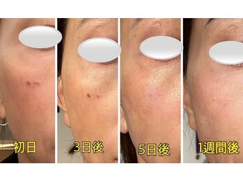 ケンビラク(Kenbiraku 健美楽)/ハイドラ　プラズマ殺菌　美容液