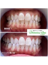 ホワイトニングサロン 名古屋駅店/【ホワイトニング施術例】