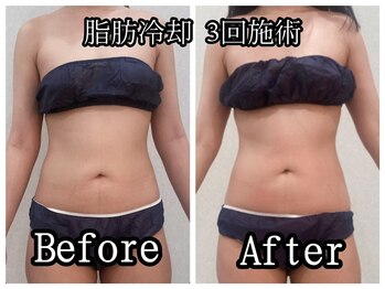 イデアルボーテ/脂肪をなくす脂肪冷却をぜひ！
