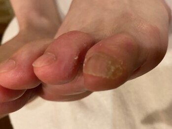 自爪のお手入れペディキュア