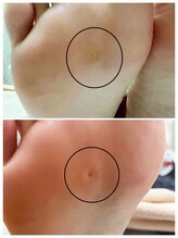 ドクターネイル爪革命 麻布十番店/【魚の目ケア】フットケア