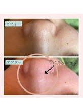 ランプ(Lampe)/◇ハイドラピーリングとプラズマ