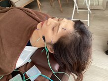 ハリファ鍼灸院 横浜関内院(HariFa鍼灸院)/美容鍼施術/美容鍼