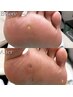 【タコ・魚の目・角質】数に限らず一律！！¥5,500