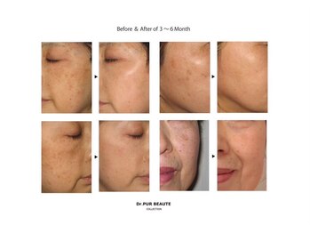 プライムビューティーラボ/BEFORE/AFTER→40代女性