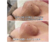 アトリエリュバン 梅田店(atelier Ruban)の雰囲気（毛穴レス♪黒ずみ角栓毛穴開きにワンランク上の高美白毛穴洗浄）