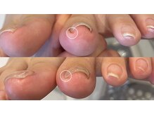 キラネイル アンド アイラッシュ by World Beauty(KIRA)/#新潟巻爪　#ペディグラス　