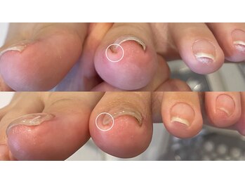 キラネイル アンド アイラッシュ by World Beauty(KIRA)/#新潟巻爪 #ペディグラス