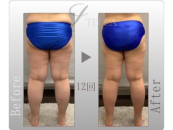 ステラ(STELLA)/下半身プレミアムの１２回の効果