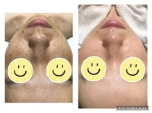 ウカ(uka)/シミケアのお客様♪