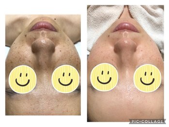 ウカ(uka)/シミケアのお客様♪