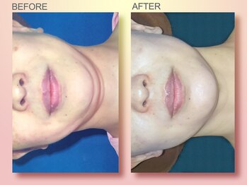 ジュリア オージェ 京橋店/ビフォーアフター/イドラリフト