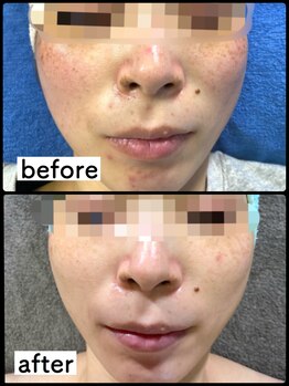 オシャレハウスシルバ(OshareHausuSILVA)/光フェイシャル