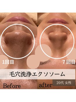 パルティノ 高崎店/7回目症例写真・20代・毛穴洗浄