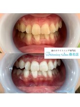 ホワイトニングサロン 三重県桑名店/ホワイトニング施術例