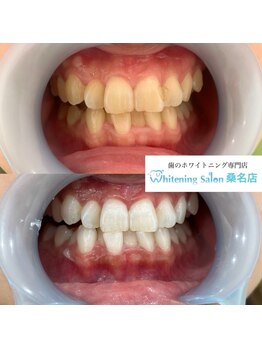 ホワイトニングサロン 三重県桑名店/ホワイトニング施術例