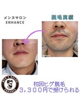 エンハンス 亀有(enhance)/脱毛実績