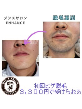 エンハンス 亀有(enhance)/脱毛実績