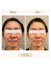 プルーム 久留米店(plume)/小顔矯正