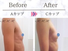メディカルサロン エム エム エム 銀座プレミアムサロン(M.M.M.)/【バストアップ例】　A→Cカップ