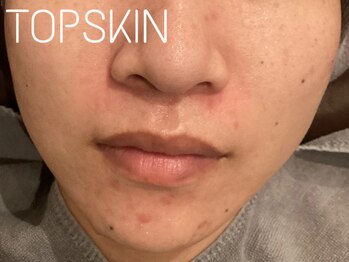 トップスキン 表参道(TOPSKIN)/ニキビ肌/敏感肌/赤ら顔にも