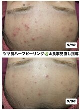 リベル(ReBelle.)/ニキビはインナーケアも必須です