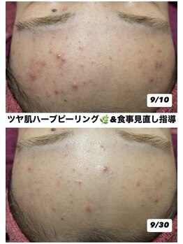 リベル(ReBelle.)/ニキビはインナーケアも必須です