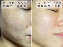 ココ 2号店(CoCo)/毛穴ケア/ハーブピーリング