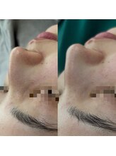 ファーファラ(Farfalla)/毛穴洗浄×水光ピーリング