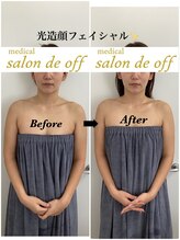 メディカルサロンドオフ 堺東店(medical salon de off)/光造顔フェイシャル★ &nbsp;施術前後