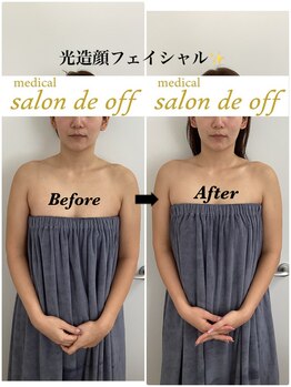 メディカルサロンドオフ 堺東店(medical salon de off)/光造顔フェイシャル★ &nbsp;施術前後